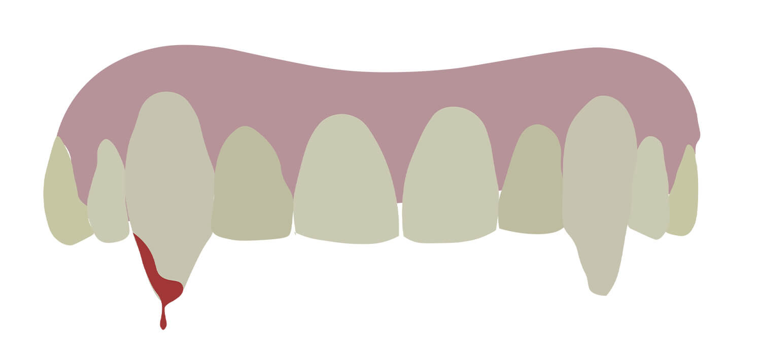 Illustrated teeth with some blood on
